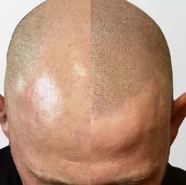 borostáshatású hajtetoálás 